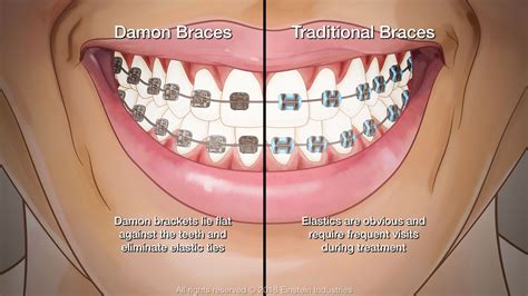 traditional braces vs damon